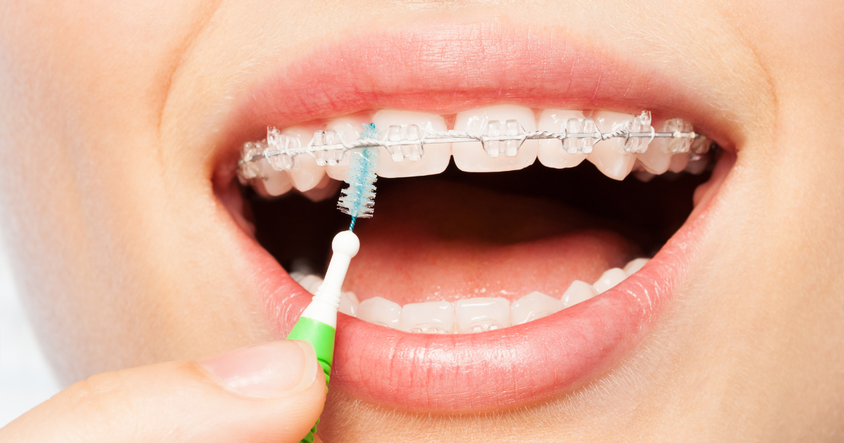 Jak používat mezizubní kartáčky a zlepšit tak dentální hygienu?
